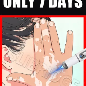 2025 Nuovo aggiornamento Penna a luce blu Risolvi strumento vitiligine 1