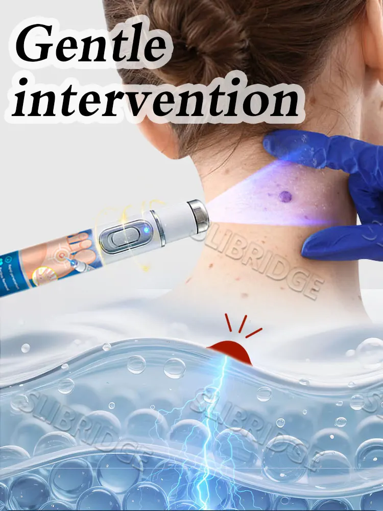 2025 Nuovo aggiornamento Laser blu Risolvi strumento verruca 4