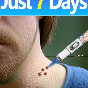 2025 Nuovo aggiornamento Laser blu Risolvi strumento verruca 1