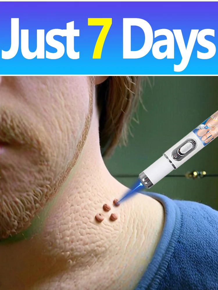 2025 Nuovo aggiornamento Laser blu Risolvi strumento verruca 1