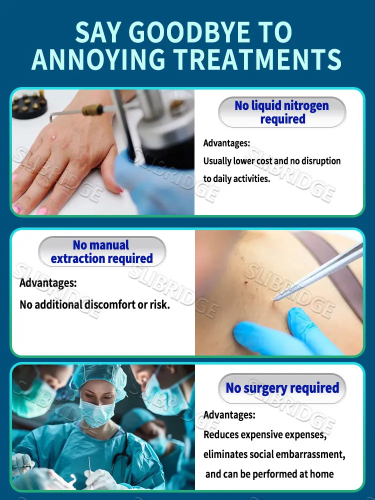 2025 Nuovo aggiornamento Laser blu Risolvi strumento verruca 5